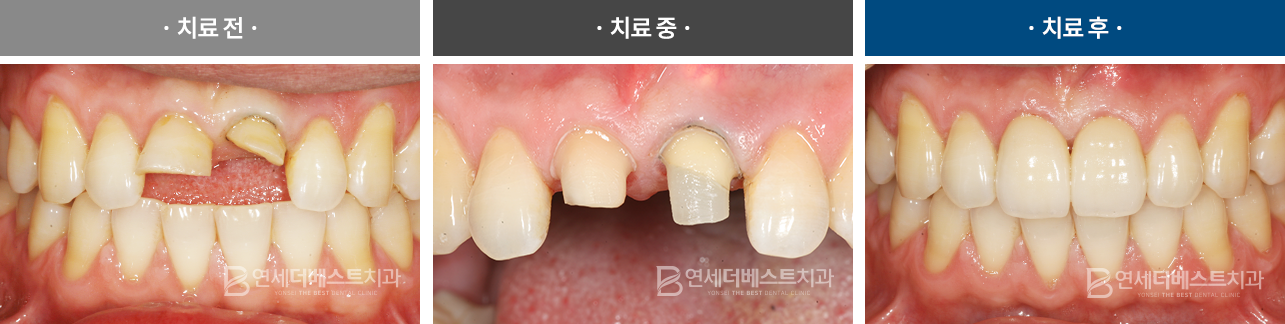 지르코니아 치료사례